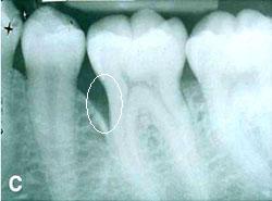 Pre-surgical view of periodontal defects
