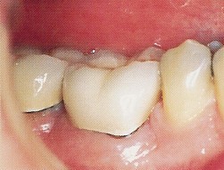 Periodontal (Gum Disease) Therapy - Crown Lengthening Surgery