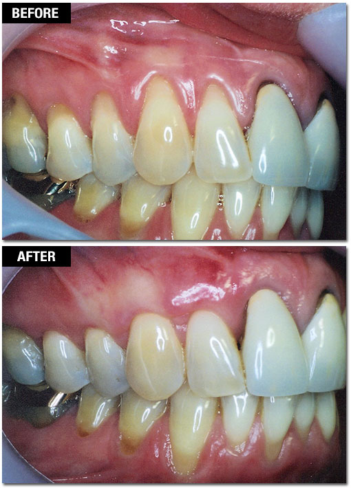 Smile Enhancement - Before and After