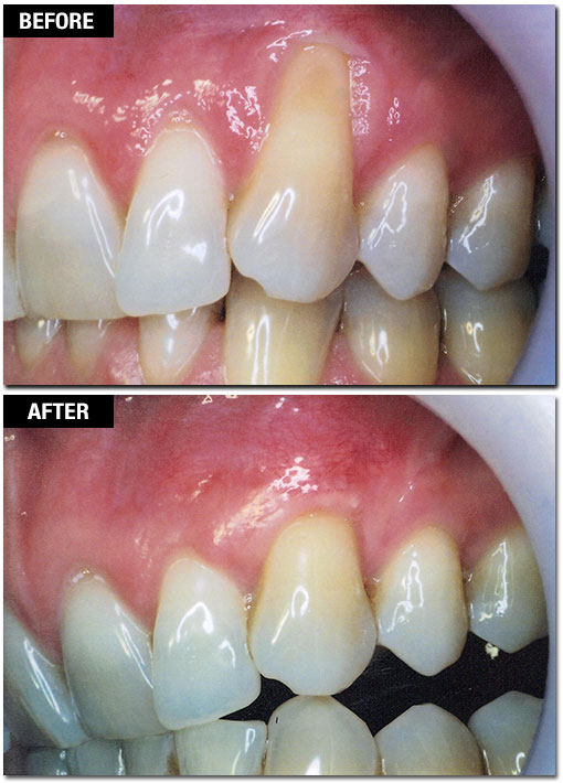 Smile Enhancement - Before and After