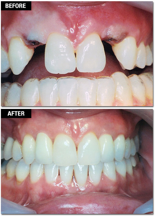 Dental Implants - Before and After