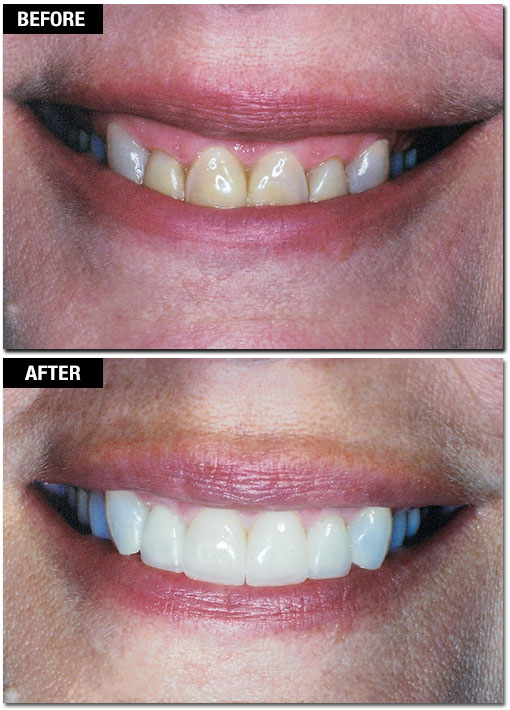 Cosmetic Laser Gum Surgery - Before and After