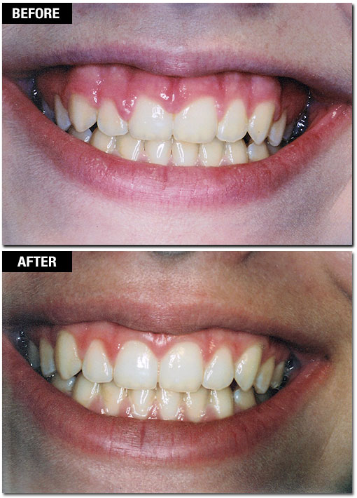 Cosmetic Laser Gum Surgery - Before and After