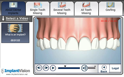 Dental Implants Video Presentation