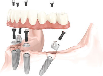 Cross Section Implant