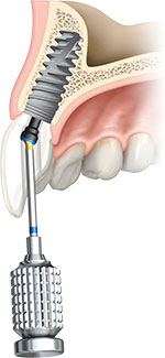 Cross Section Implant