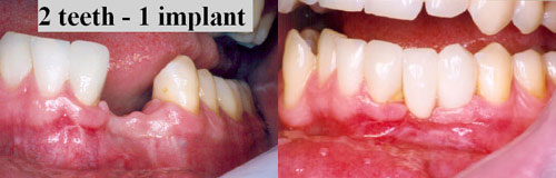 dental implants front teeth