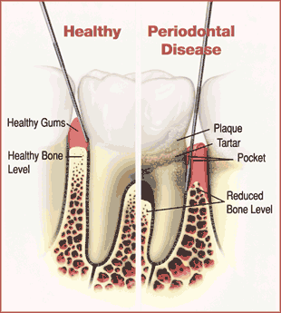 Gum Disease Surgical Treatment