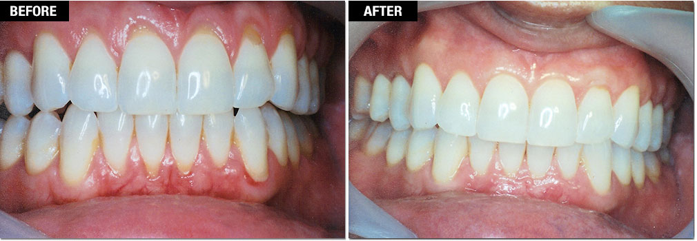 receding gums surgery