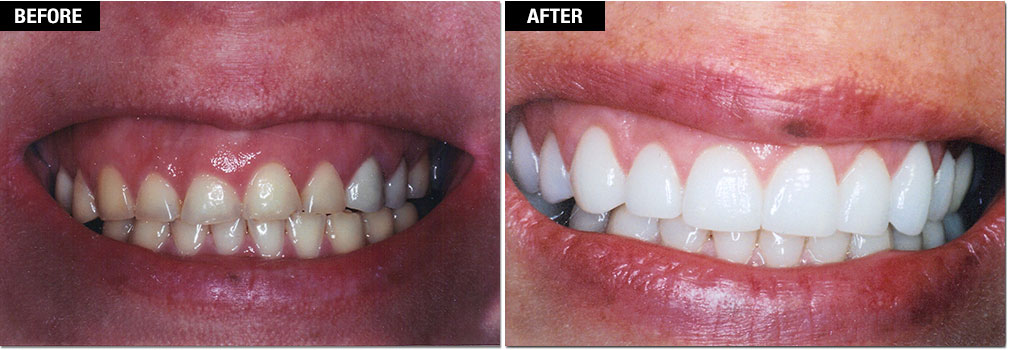 Gum shaping or recontouring can improve a gummy smile