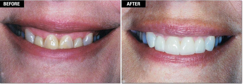 Laser Gum Lift And Contouring - Westlake Smile Studio